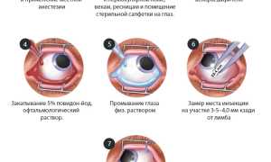 Дегенерация макулы (желтого пятна) и заднего полюса