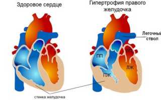 Гипертрофия правого желудочка на ЭКГ. Признаки, лечение