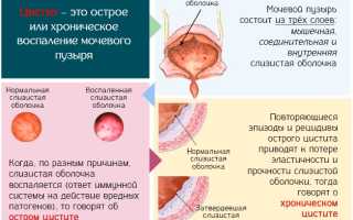 Как собрать мочу на бак посев на флору при беременности