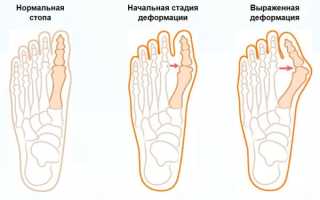 Супинаторы для стопы при плоскостопии. Где купить, как сделать, выбрать, цена, фото