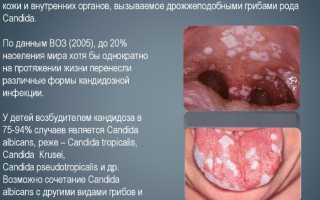 Кандидоз во рту. Фото, симптомы и лечение у взрослых, детей