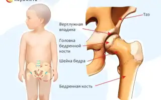 Артрит тазобедренного сустава. Симптомы и лечение у пожилых, детей. Препараты, народные средства