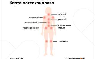 Остеохондроз грудного отдела позвоночника. Симптомы и лечение, препараты, гимнастика