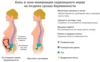 Болит спина при беременности на ранних сроках. Признаки, что делать