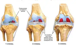 Остеопороз коленного сустава 1-2-3 степени. Симптомы, лечение