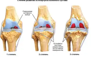 Остеопороз коленного сустава 1-2-3 степени. Симптомы, лечение