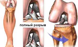 Передняя крестообразная связка. Анатомия, разрыв, повреждение, изменения, лечение