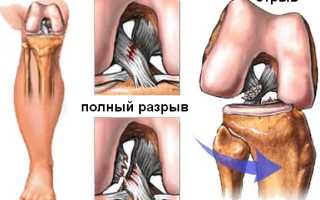 Передняя крестообразная связка. Анатомия, разрыв, повреждение, изменения, лечение