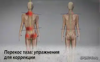 Перекос таза. Симптомы, упражнения для нормализации положения