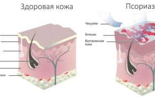 Лечение псориаза народными средствами в домашних условиях