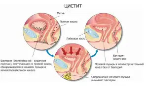 Цистит у детей. Симптомы и лечение в домашних условиях