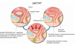 Цистит у детей. Симптомы и лечение в домашних условиях