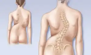 Люмбаго с ишиасом. Что это такое, как лечить болезнь, симптомы