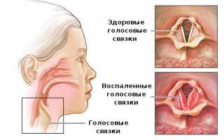 Пропадает голос. Причины, если горло не болит, как лечить