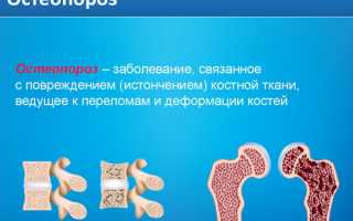 Регионарный остеопороз. Что это такое, лечение