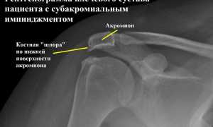 Импиджмент-синдром плечевого сустава. Лечение, рентген