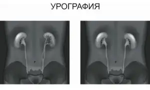 Внутривенная урография почек с применением контрастного вещества
