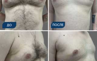 Операция по удалению гинекомастии у мужчин. Цена, как проходит