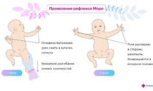 Рефлекс Моро у новорожденных, взрослых. Что это такое, как избавиться