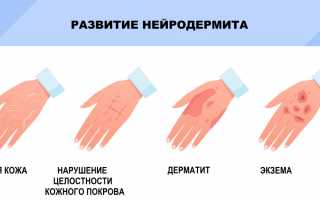 Нейродерматиты. Виды, фото и лечение у взрослых, детей. Причины и симптомы