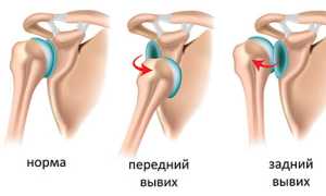 Вывих плечевого сустава. Лечение, реабилитация, упражнения, симптомы, первая помощь, рентген