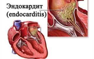 Эндокардит у взрослых. Симптомы, диагностика и лечение