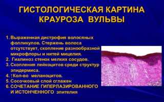 Склероатрофический лихен у девочек, женщин. Народные средства, препараты