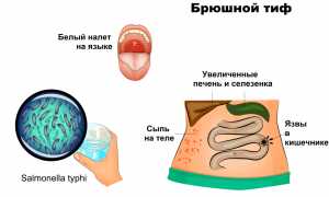 Брюшной тиф. Симптомы у детей, лечение