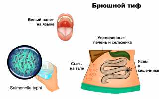Брюшной тиф. Симптомы у детей, лечение