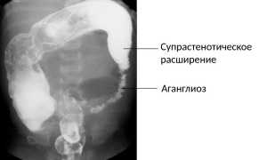 Болезнь Гиршпрунга у детей. Рентген, лечение