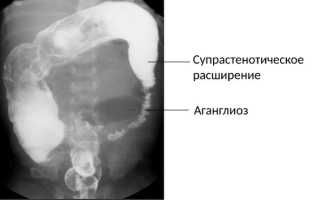 Болезнь Гиршпрунга у детей. Рентген, лечение