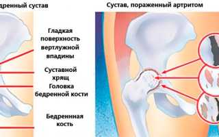 Лечение тазобедренного сустава народными средствами, без операции, инъекциями