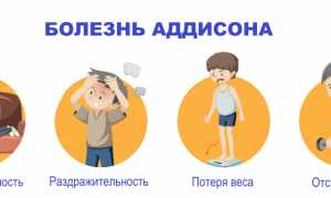 Болезнь Аддисона (бронзовая). Что это такое, симптомы