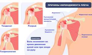 Причины боли в левом плече и предплечье. Резкая, ноющая, тупая боль и рекомендации врачей