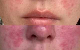 Мирвазо Дерм (Mirvaso Derm) гель. Отзывы, фото до и после
