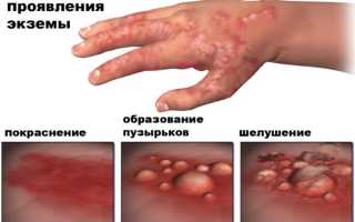 Мази от экземы на коже у взрослых. Список эффективных гормональные и негормональные