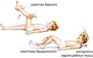 Симптом Кернига и Брудзинского при менингите, ОНМК, паркинсоне, инсульте. Что это такое, как проверить