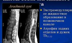 Периневральные кисты позвоночника в пояснично-крестцовом отделе