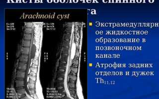 Периневральные кисты позвоночника в пояснично-крестцовом отделе