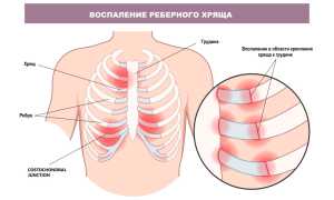 Боль между ребрами посередине спереди, при нажатии, если тяжело дышать