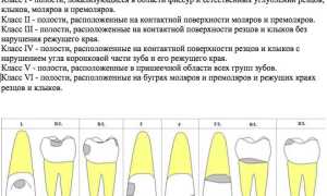 Классификация кариеса по Блэку в картинках. Таблица