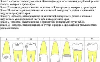 Классификация кариеса по Блэку в картинках. Таблица
