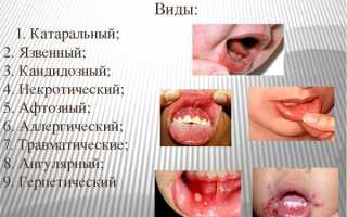 Стоматит у новорожденного ребенка. Фото во рту на десне, языке, губе, нёбе. Лечение