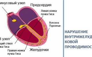 Замедление внутрипредсердной проводимости. Признаки на ЭКГ, причины, лечение