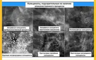 Микрокальцинаты в молочной железе. Что это, единичные, сгруппированные, полиморфные, множественные. Лечение народными средствами, препараты
