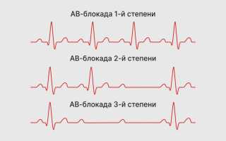 АВ блокада 1-2-3 степени на ЭКГ Мобитц. Что это, причины, лечение