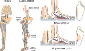 Плоскостопие. Симптомы у взрослых, степени, как определить, лечение