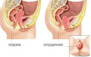 Опущение задней стенки матки. Симптомы и лечение