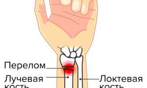 Перелом руки. Признаки, симптомы со смещением, сколько заживает