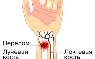 Перелом руки. Признаки, симптомы со смещением, сколько заживает